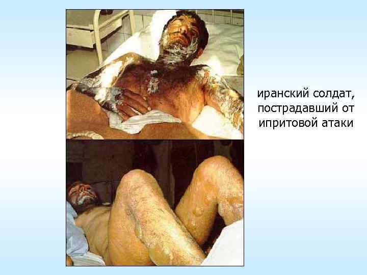 иранский солдат, пострадавший от ипритовой атаки 