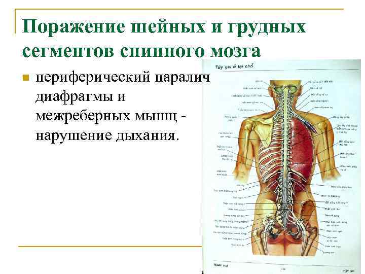 Поражение шейных и грудных сегментов спинного мозга n периферический паралич диафрагмы и межреберных мышц