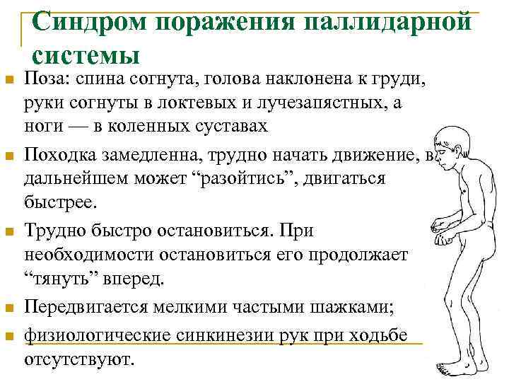  Синдром поражения паллидарной системы n Поза: спина согнута, голова наклонена к груди, руки