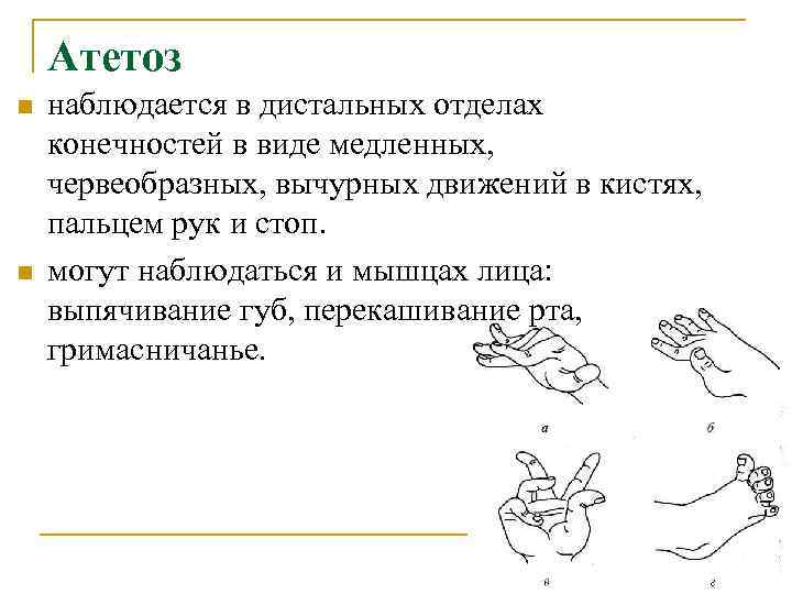  Атетоз n наблюдается в дистальных отделах конечностей в виде медленных, червеобразных, вычурных движений