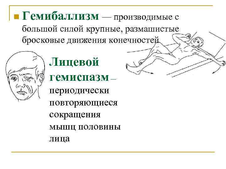 n Гемибаллизм — производимые с большой силой крупные, размашистые бросковые движения конечностей Лицевой гемиспазм