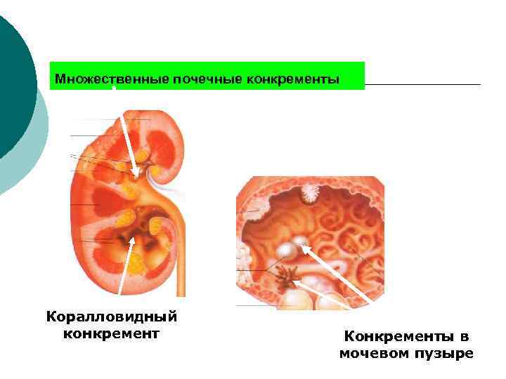 Множественные почечные конкременты Коралловидный конкремент Конкременты в мочевом пузыре 