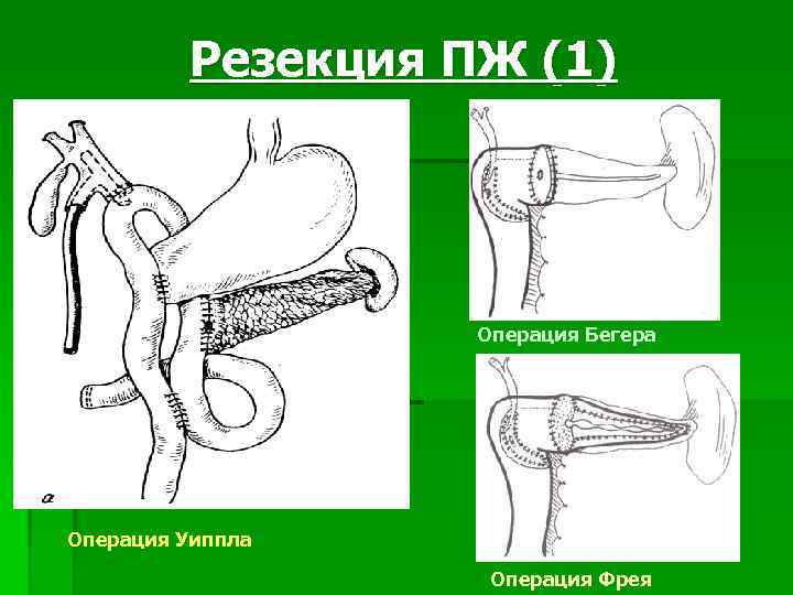 Резекция ПЖ (1) Операция Бегера Операция Уиппла Операция Фрея 