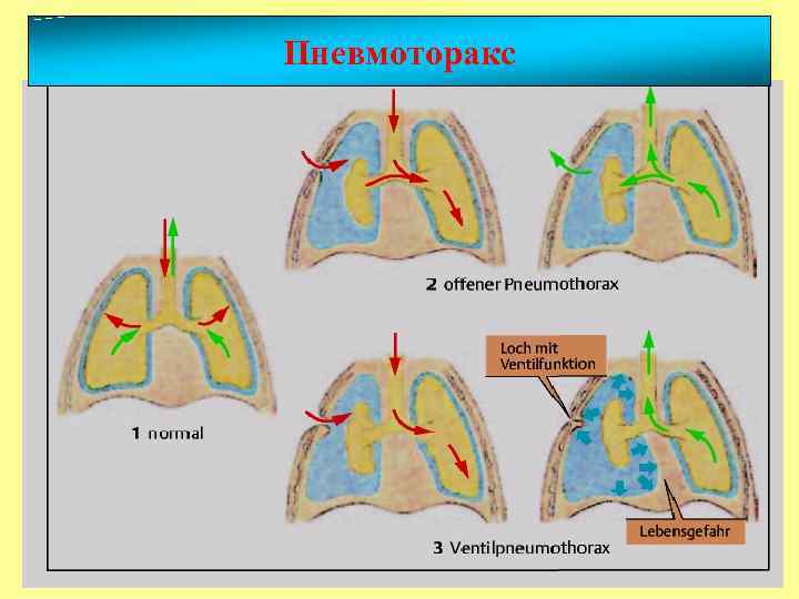 Пневмоторакс 