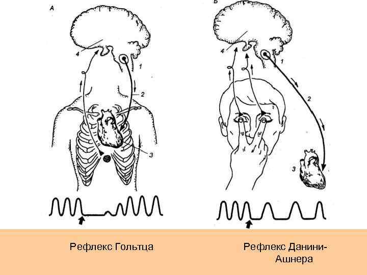 Схема глазосердечного рефлекса