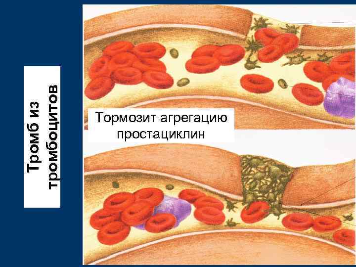 Тромб из тромбоцитов Тормозит агрегацию простациклин 