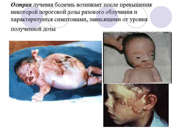 Острая лучевая болезнь возникает после превышения некоторой пороговой дозы разового облучения и характеризуется симптомами,