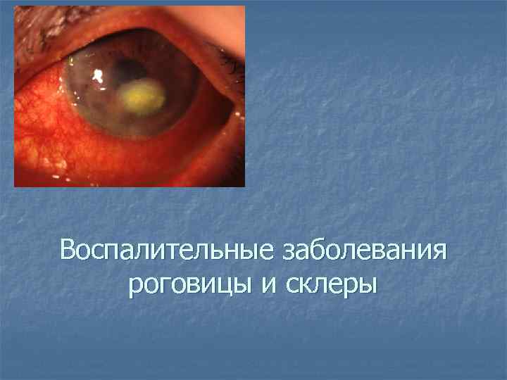 Воспалительные заболевания роговицы и склеры 