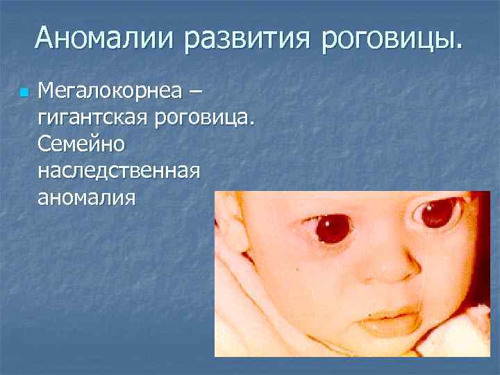 Аномалии развития роговицы. n Мегалокорнеа – гигантская роговица. Семейно наследственная аномалия 