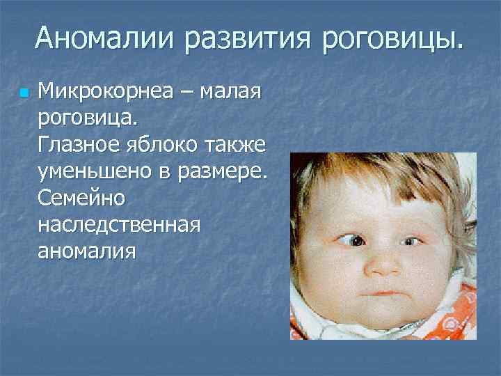 Аномалии развития роговицы. n Микрокорнеа – малая роговица. Глазное яблоко также уменьшено в размере.