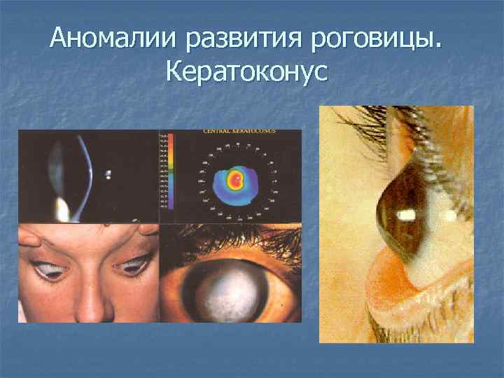 Аномалии развития роговицы. Кератоконус 
