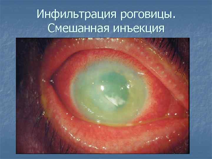 Инфильтрация роговицы. Смешанная инъекция 