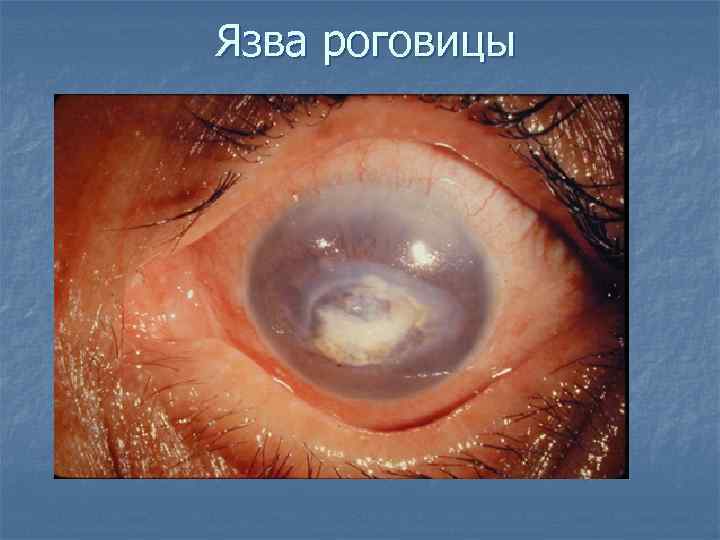 Язва роговицы 