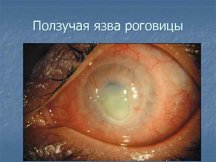 Ползучая язва роговицы 