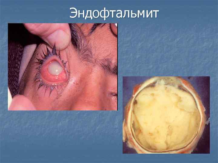 Эндофтальмит 