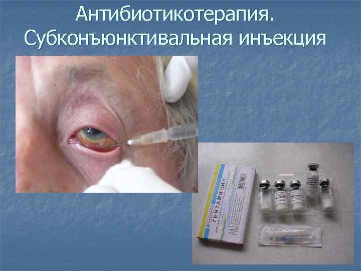 Антибиотикотерапия. Субконъюнктивальная инъекция 