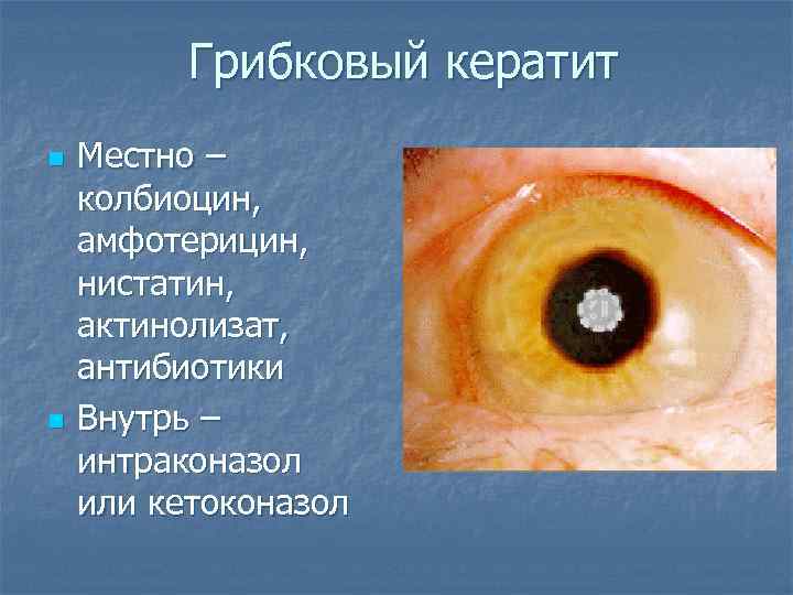 Грибковый кератит n n Местно – колбиоцин, амфотерицин, нистатин, актинолизат, антибиотики Внутрь – интраконазол