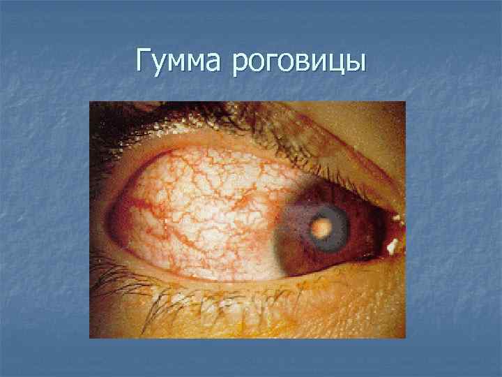 Гумма роговицы 