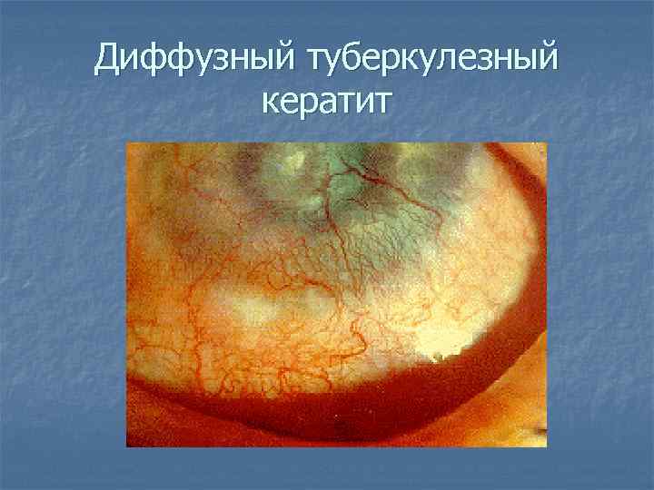 Диффузный туберкулезный кератит 