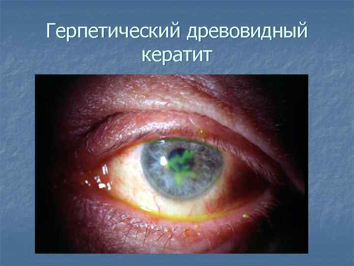 Герпетический древовидный кератит 