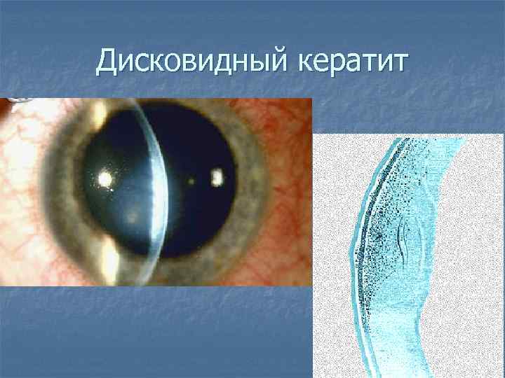 Дисковидный кератит 