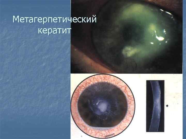 Метагерпетический кератит 