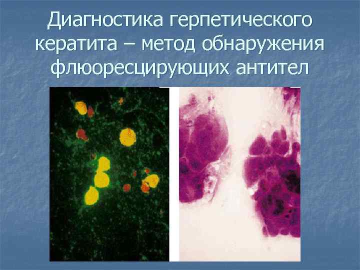 Диагностика герпетического кератита – метод обнаружения флюоресцирующих антител 