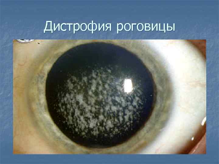 Дистрофия роговицы 
