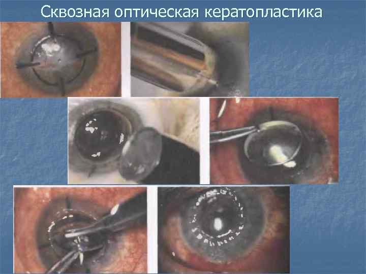Сквозная оптическая кератопластика 