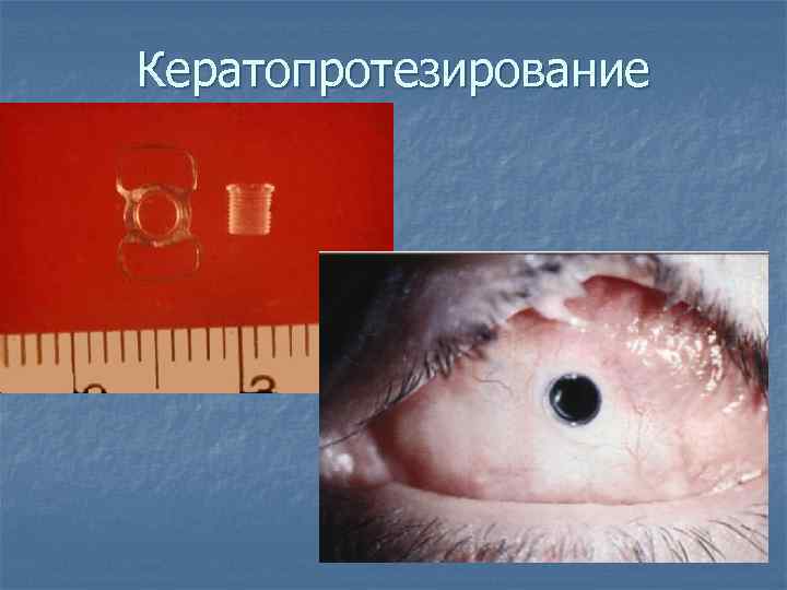 Кератопротезирование 