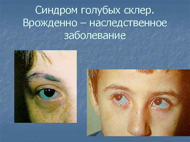 Синдром голубых склер. Врожденно – наследственное заболевание 