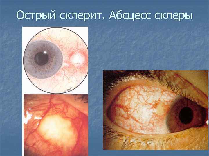 Острый склерит. Абсцесс склеры 