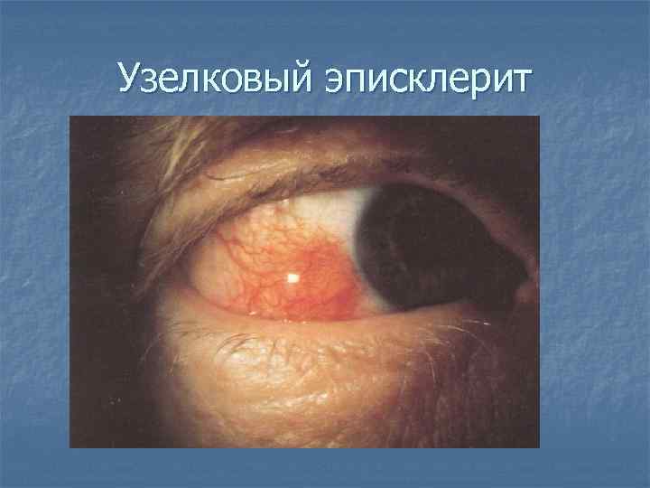 Узелковый эписклерит 