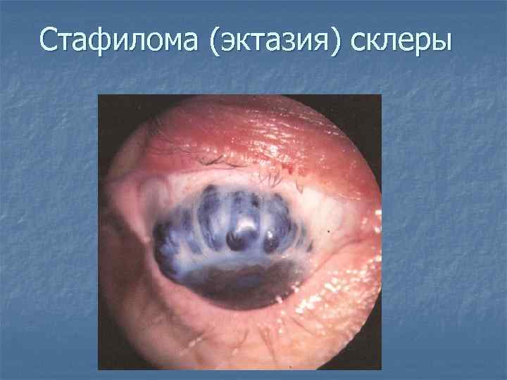 Стафилома (эктазия) склеры 