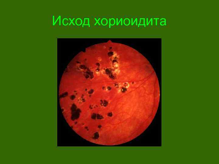 Исход хориоидита 