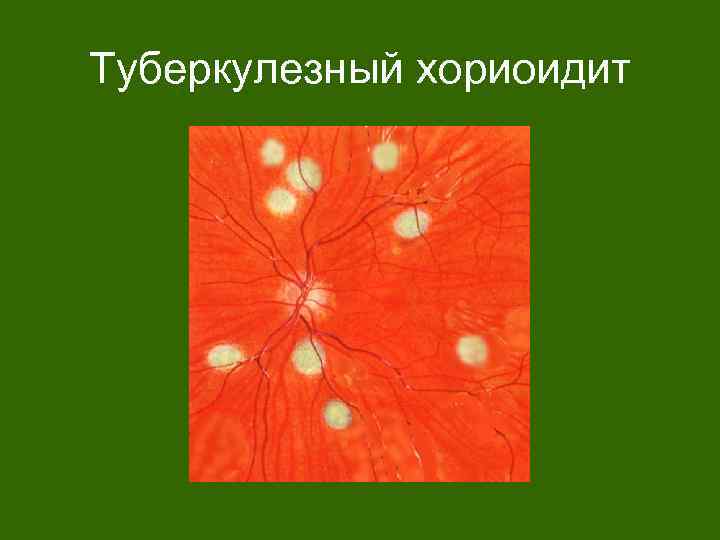Туберкулезный хориоидит 