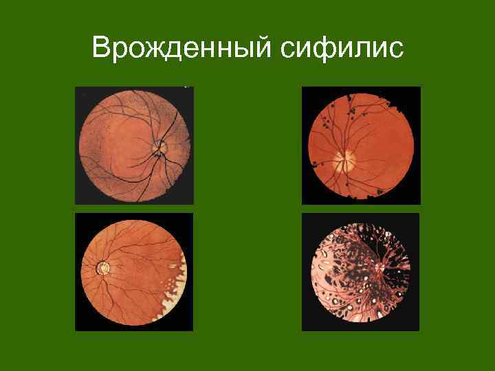 Врожденный сифилис 