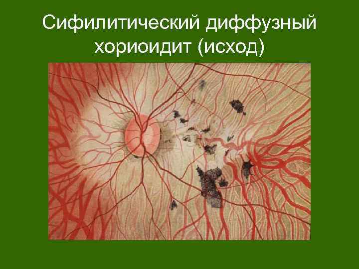 Сифилитический диффузный хориоидит (исход) 