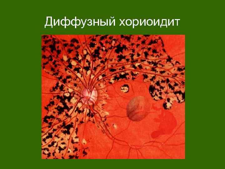 Диффузный хориоидит 