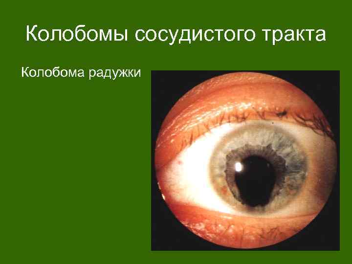 Колобомы сосудистого тракта Колобома радужки 