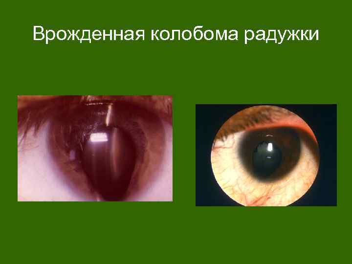 Врожденная колобома радужки 