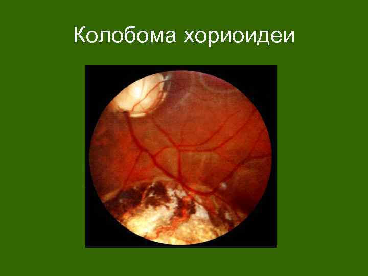 Колобома хориоидеи 