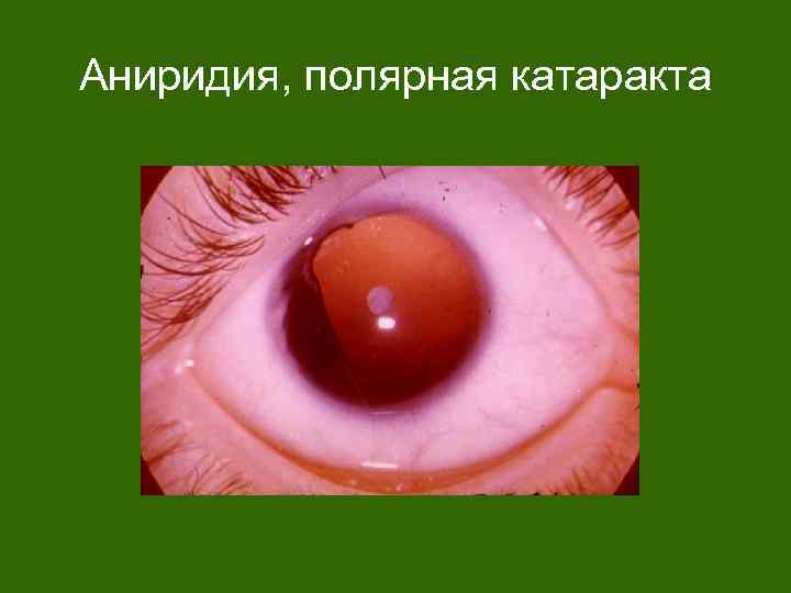 Аниридия, полярная катаракта 