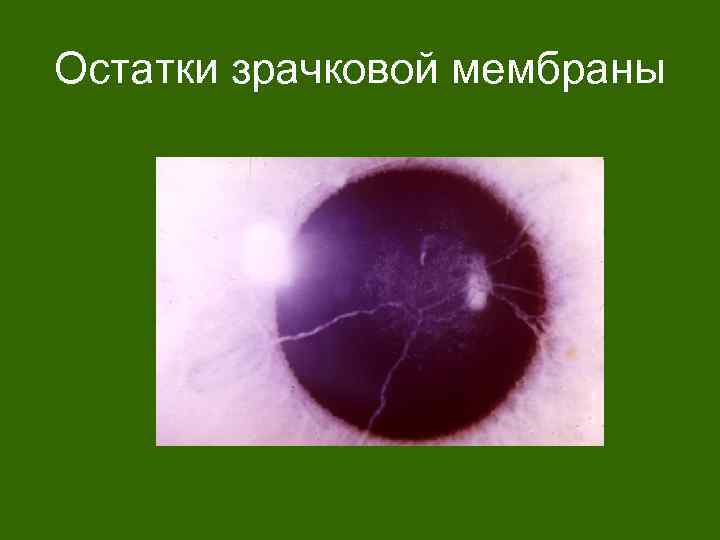 Остатки зрачковой мембраны 