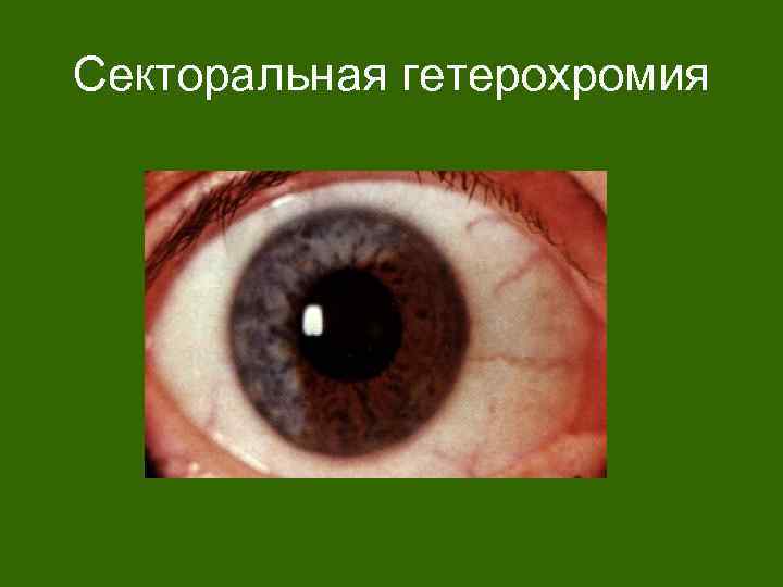 Секторальная гетерохромия 