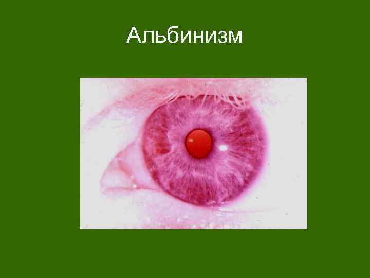Альбинизм 