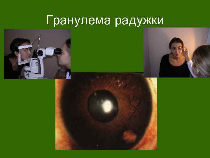 Гранулема радужки 