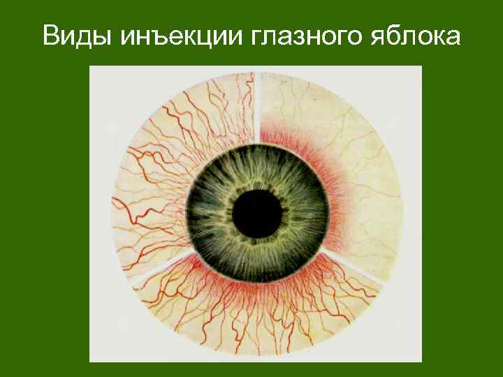 Виды инъекции глазного яблока 