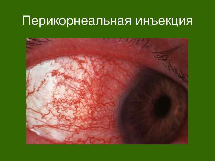 Перикорнеальная инъекция 