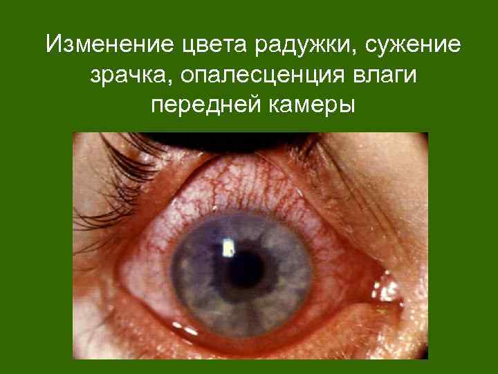 Изменение цвета радужки, сужение зрачка, опалесценция влаги передней камеры 